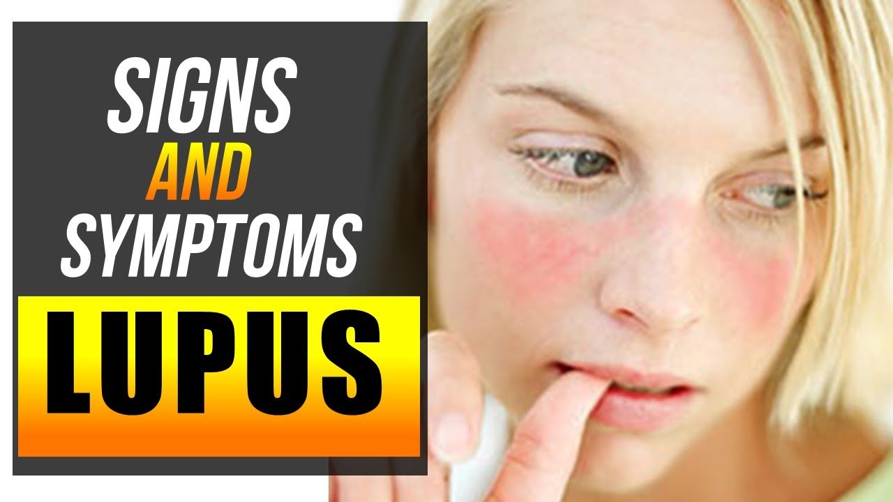 What are the Symptoms of Lupus? - Factual Facts - Facts about the world ...